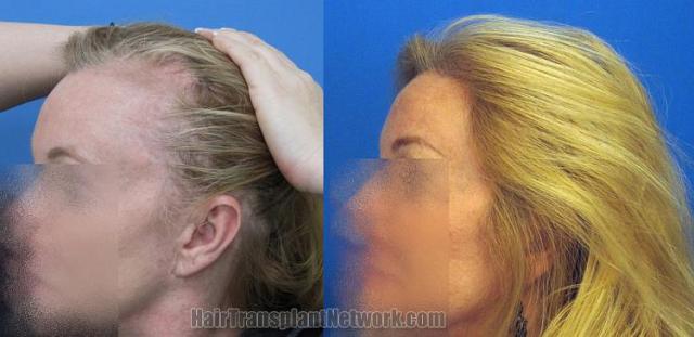 Hair transplantation surgery before and after images