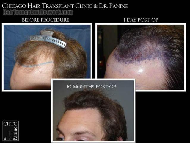 Hair restoration procedure before and after pictures