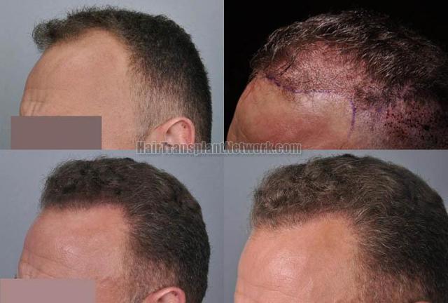 Hair transplantation surgery before and after pictures