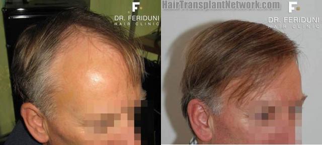 Hair restoration procedure results