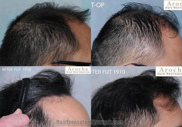 Hair transplantation surgery before and after photos