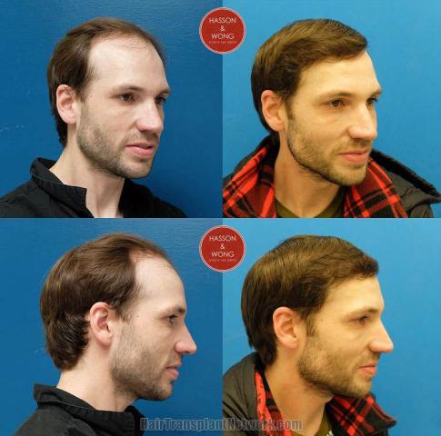 Hair transplantation surgery before and after images