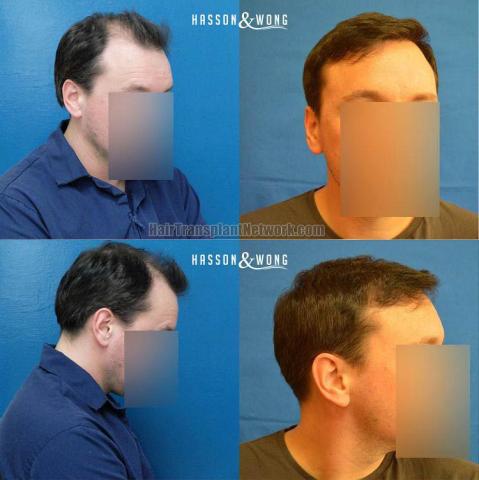 Hair transplantation surgery before and after images