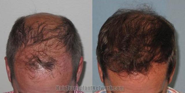 Hair restoration procedure before and after pictures