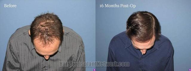 Top view images before and after hair transplant 