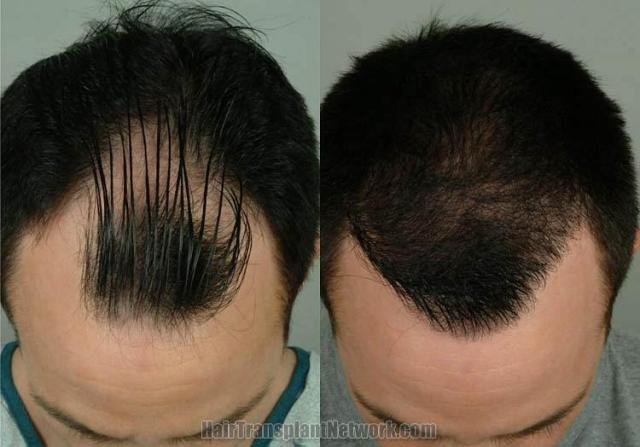 Before and after hair transplant procedure images