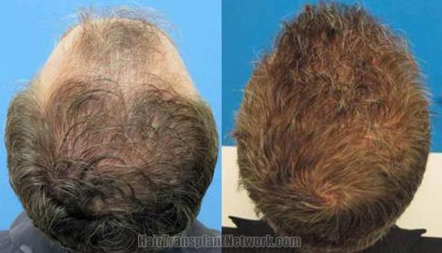 Back view before and after hair transplantation photos