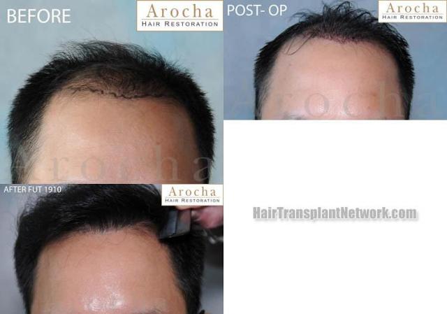 Hair restoration procedure before and after results