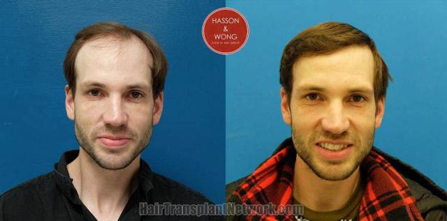 Hair restoration procedure before and after results