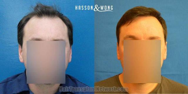 Hair restoration procedure before and after results