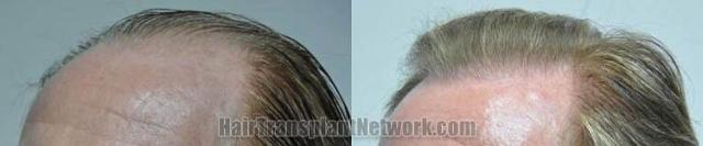 Hair transplantation surgery before and after images