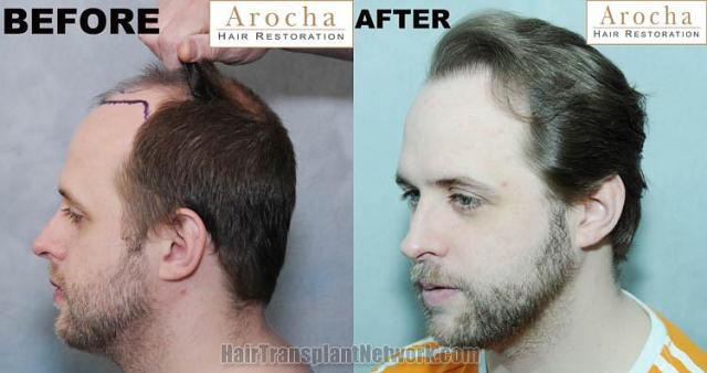 Hair transplantation surgery before and after images