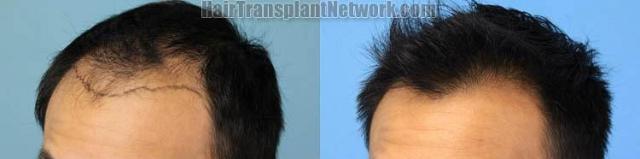 Hair transplantation surgery before and after images