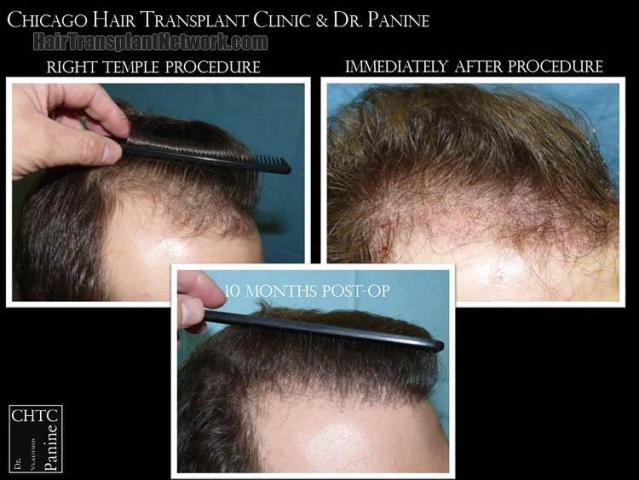 Hair transplantation surgery before and after images