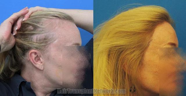 Hair transplantation surgery before and after photos