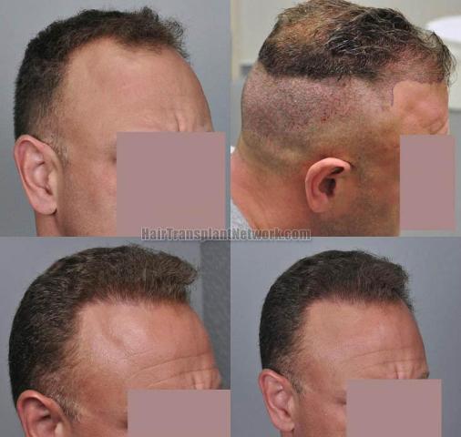 Hair transplantation surgery before and after images