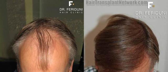 Top view before and after hair restoration results