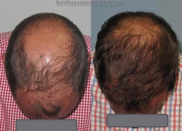 Hair transplantation surgery before and after photos