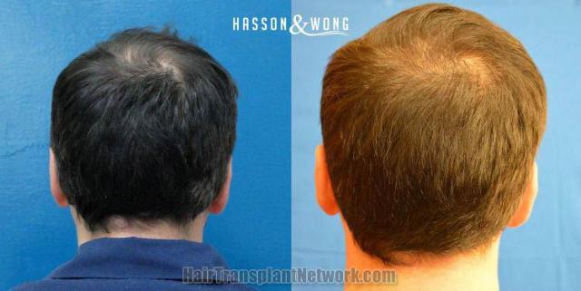 Hair restoration procedure before and after pictures