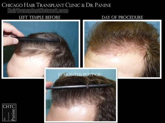 Hair transplantation surgery before and after pictures