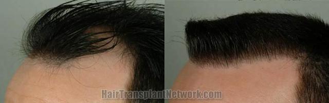 Hair transplantation surgery before and after photos