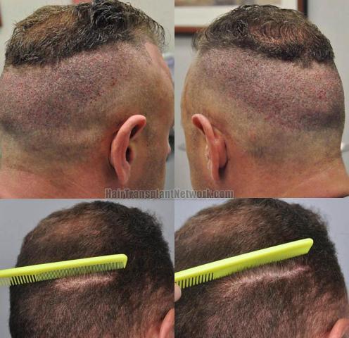 Hair restoration procedure before and after pictures