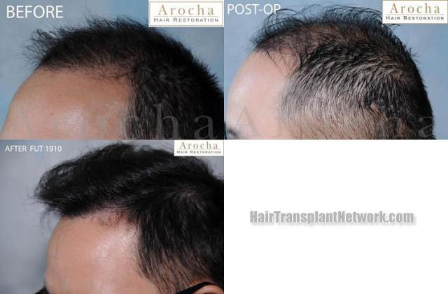 Hair transplantation surgery before and after images