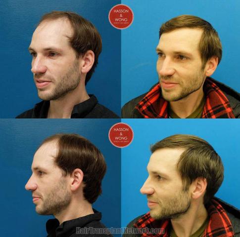 Hair transplantation surgery before and after pictures