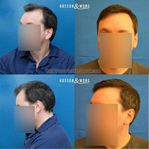 Hair transplantation surgery before and after pictures