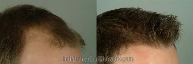 Before and after hair transplantation result photographs