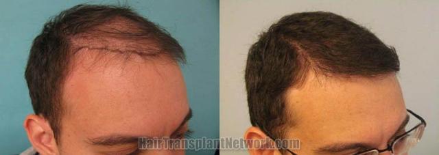 Before and after surgical hair restoration images