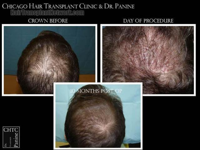 Hair restoration procedure before and after results