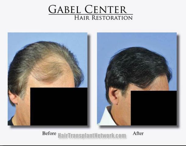 Hair transplantation surgery before and after images