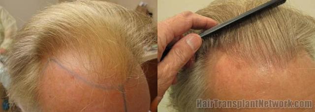 Hair restoration procedure before and after pictures