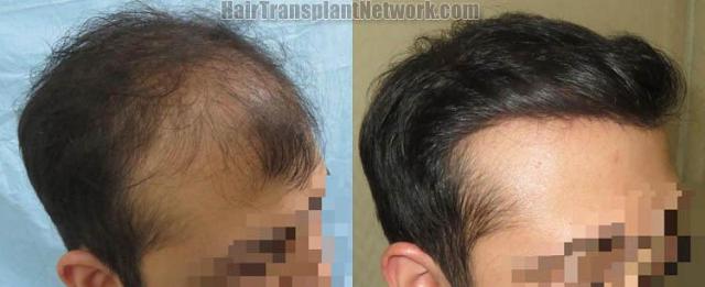 Hair restoration procedure before and after pictures