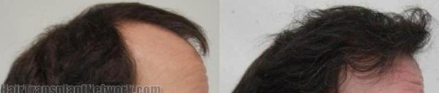 Hair transplantation surgery before and after images