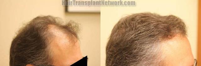 Hair transplantation surgery before and after photos