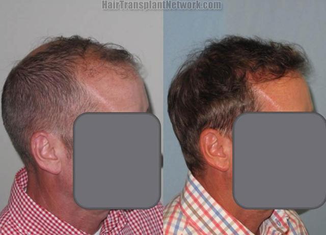 Hair transplantation surgery before and after images