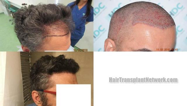 Hair restoration procedure before and after results