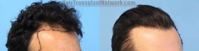 Hair transplantation surgery before and after images