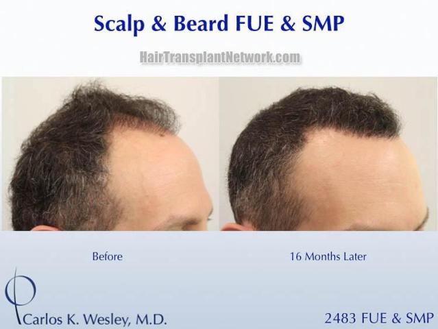 Hair restoration procedure before and after results