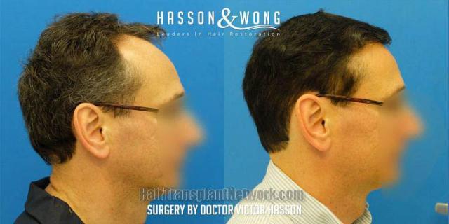 Hair restoration procedure before and after results