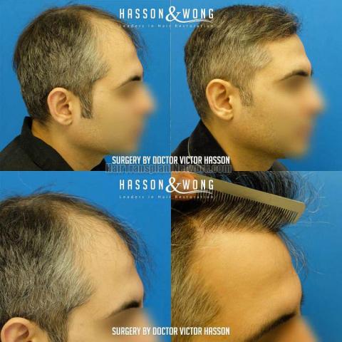 Hair restoration procedure before and after result images