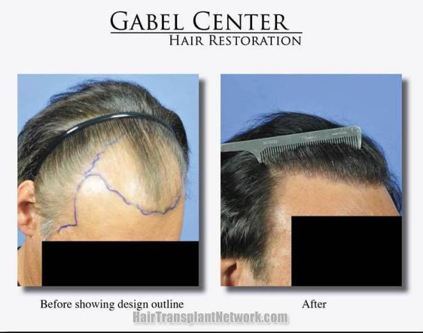 Hair transplant surgery before and after photos