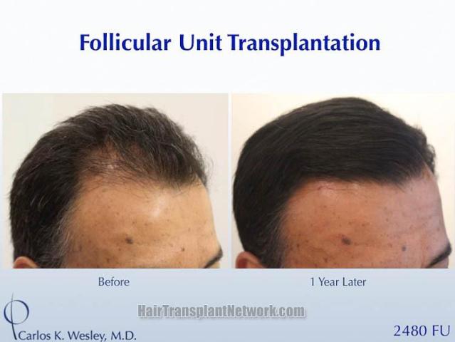 Hair restoration procedure before and after result images