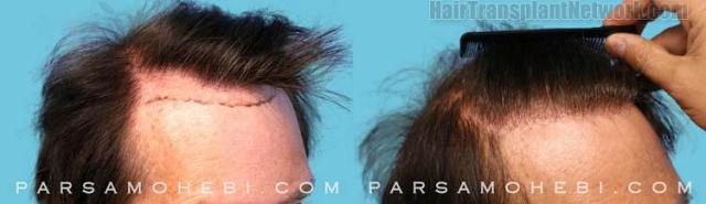 Hair restoration procedure before and after result images