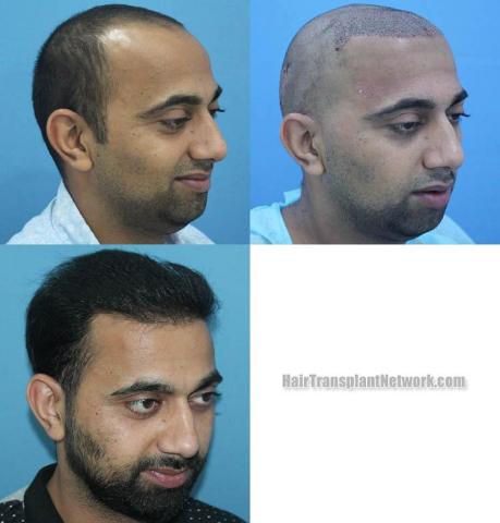 Hair restoration procedure after result images