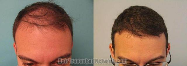 Hair transplant surgery before and after photos