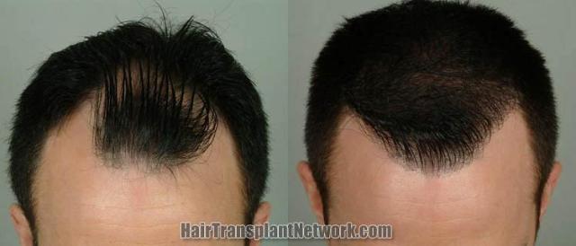 Hair restoration procedure before and after results