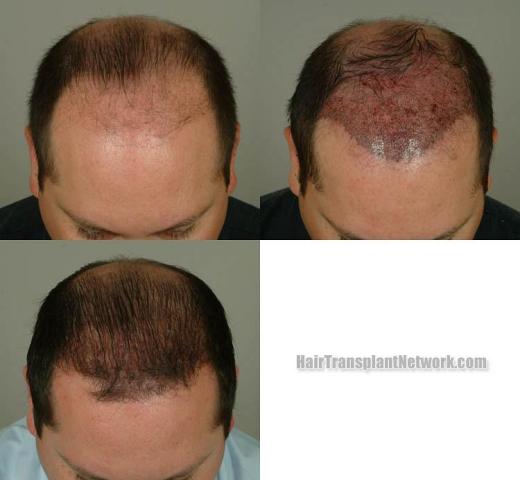 Hair transplantation surgery before and after pictures